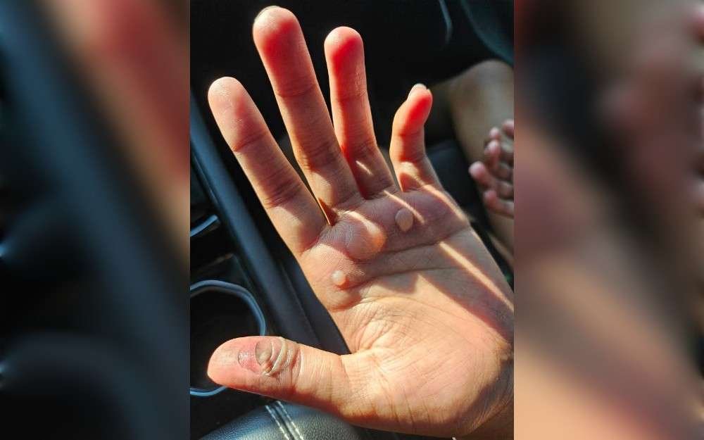 After being made to perform bear crawls on the track in the sweltering heat, several girls on the majorette team at Warren Central High School in Indianapolis,United States, sustained severe blisters and burns.